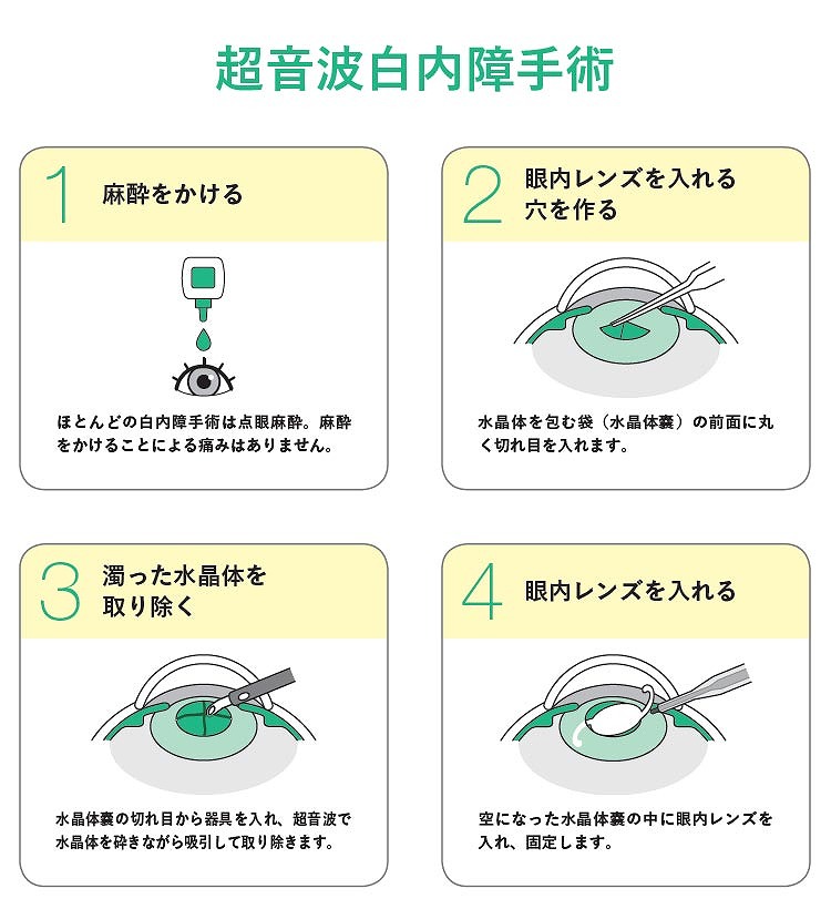 当院の白内障手術について